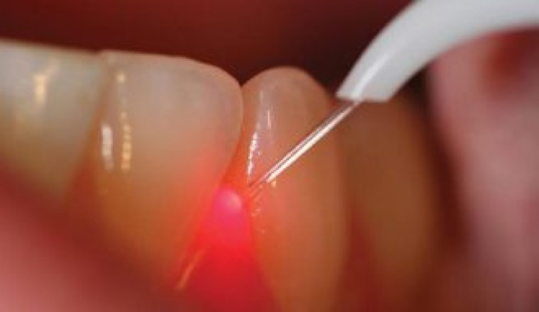 Root Canal Treatment In Abu Dhabi | Emirates Royal Center